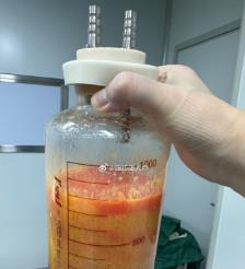 平凉水动力吸脂手术要做多久？